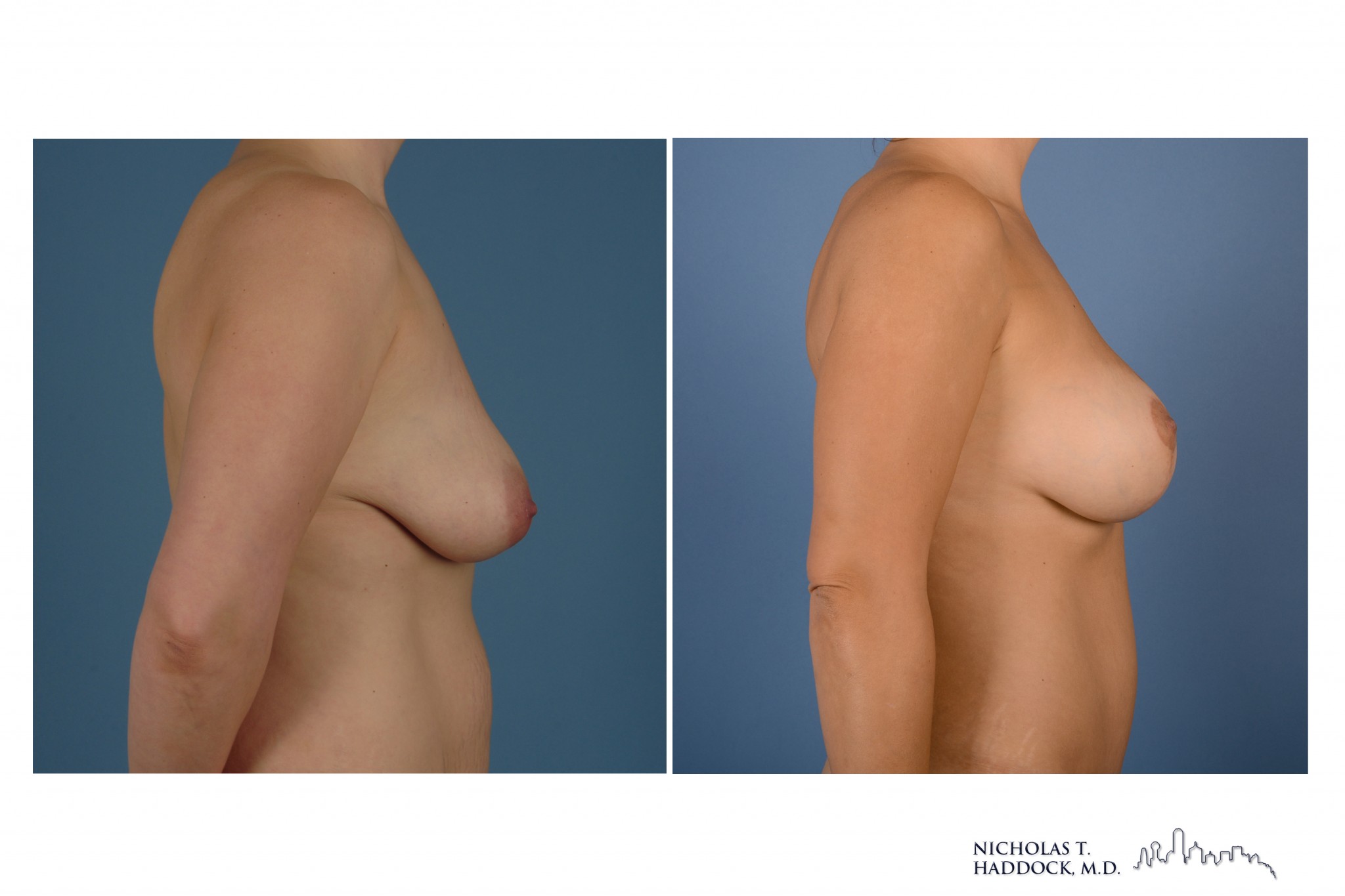 Breast Augmentation Mastopexy Breast Augmentation Mastopexy