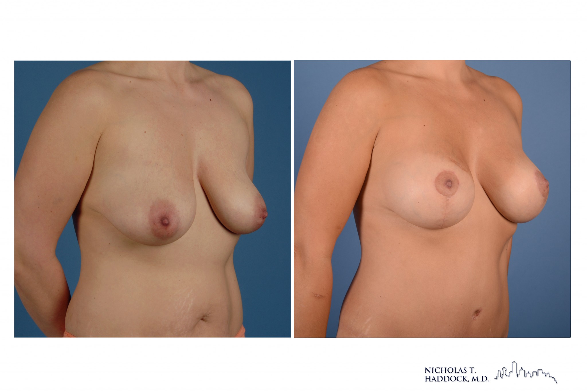Breast Augmentation Mastopexy