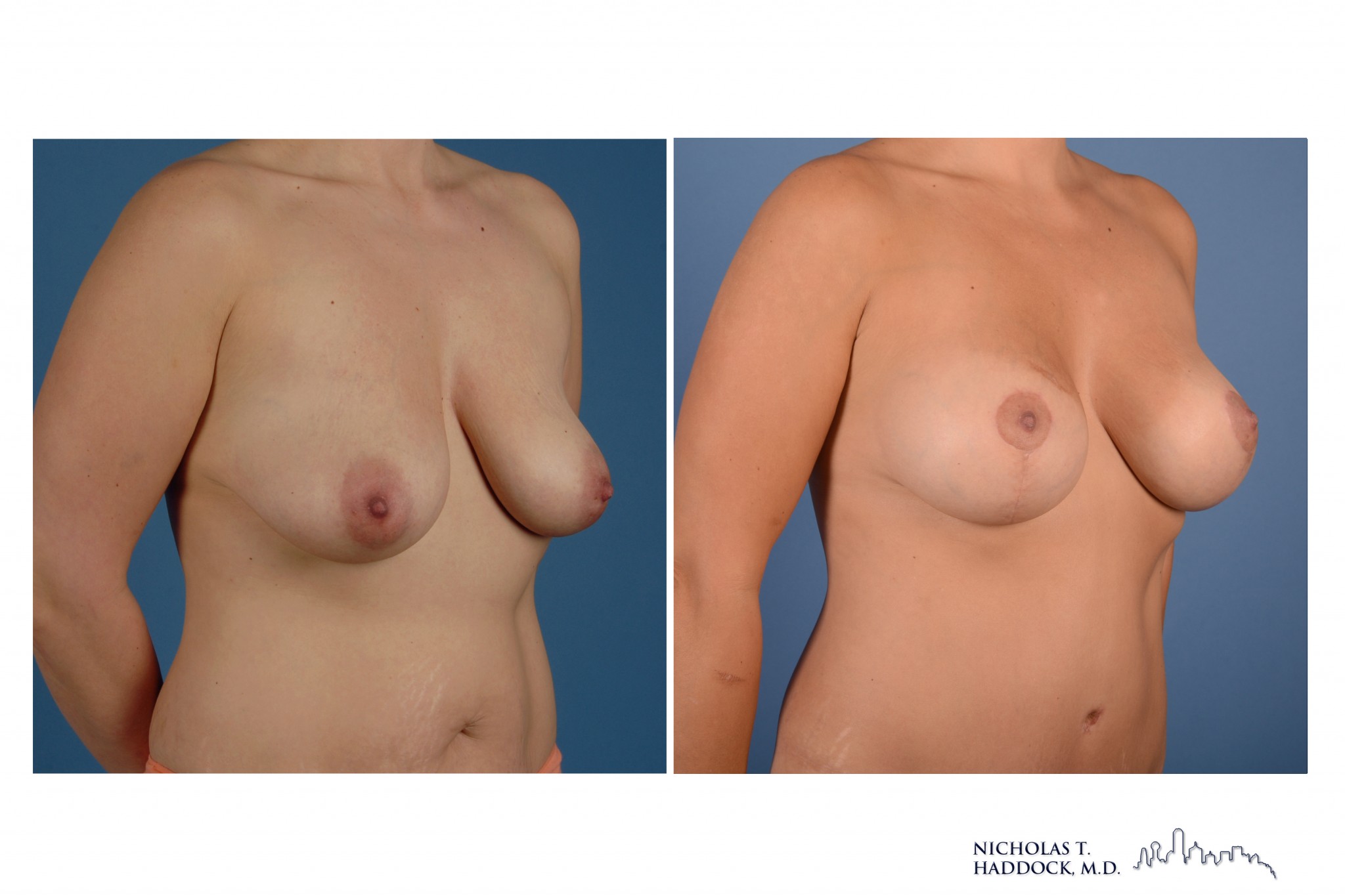 Breast Augmentation Mastopexy Breast Augmentation Mastopexy