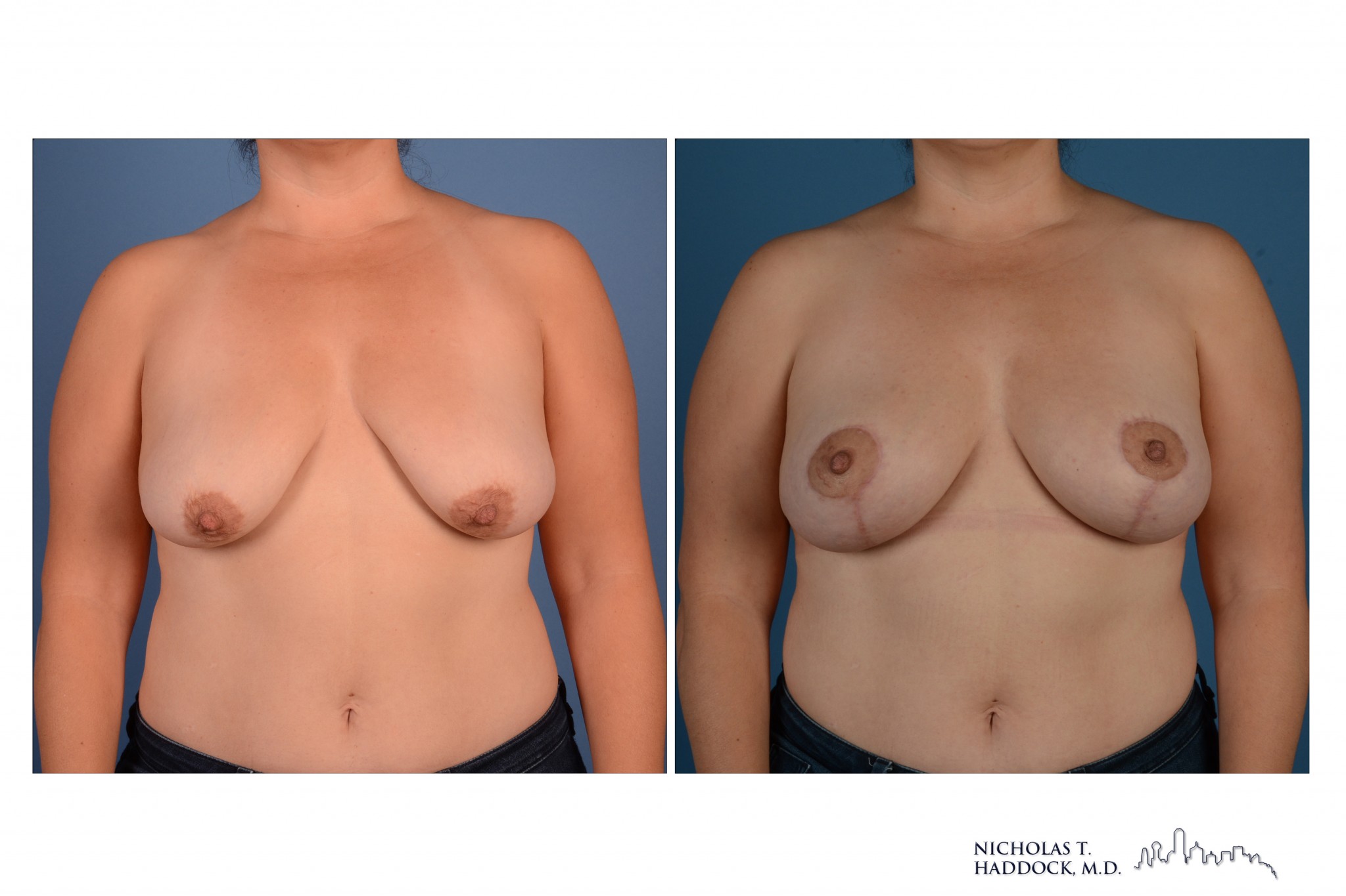 Breast Augmentation Mastopexy