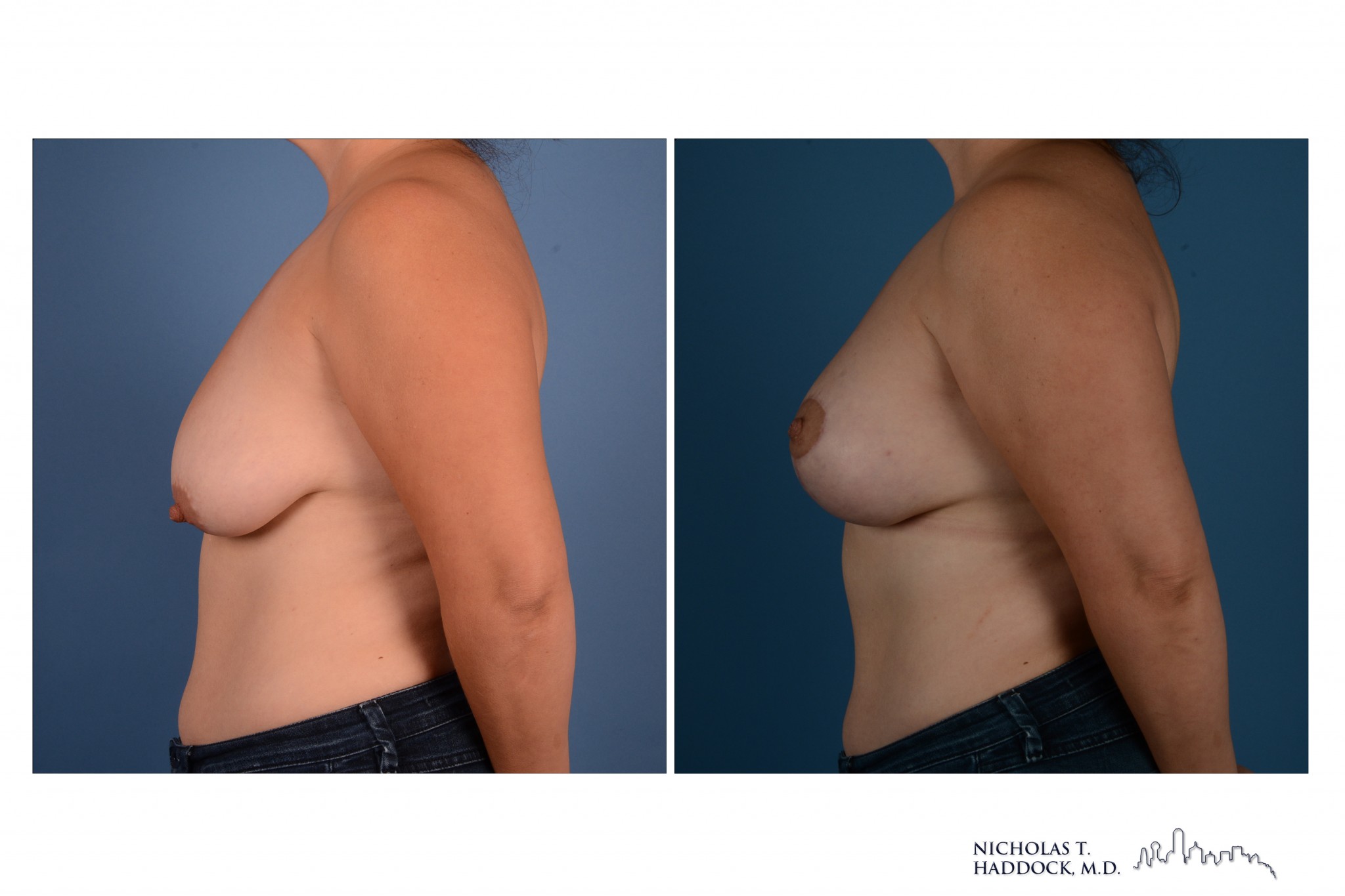 Breast Augmentation Mastopexy Breast Augmentation Mastopexy