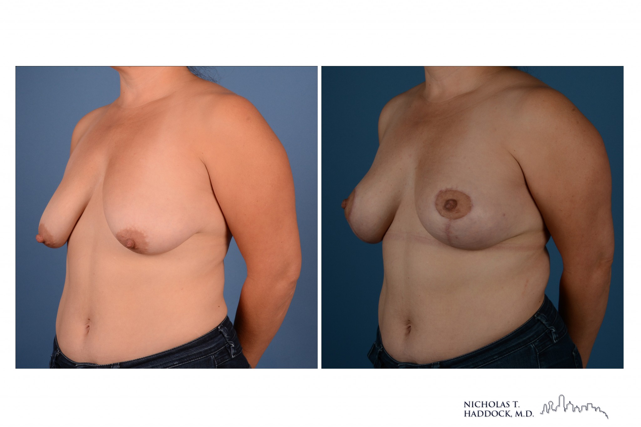 Breast Augmentation Mastopexy Breast Augmentation Mastopexy