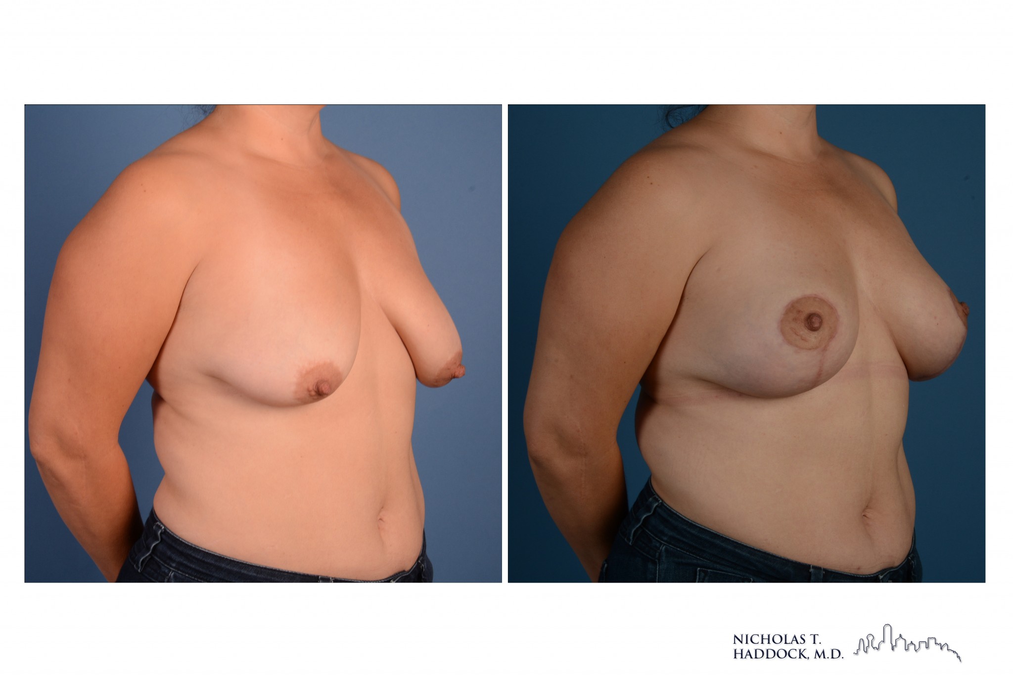 Breast Augmentation Mastopexy Breast Augmentation Mastopexy