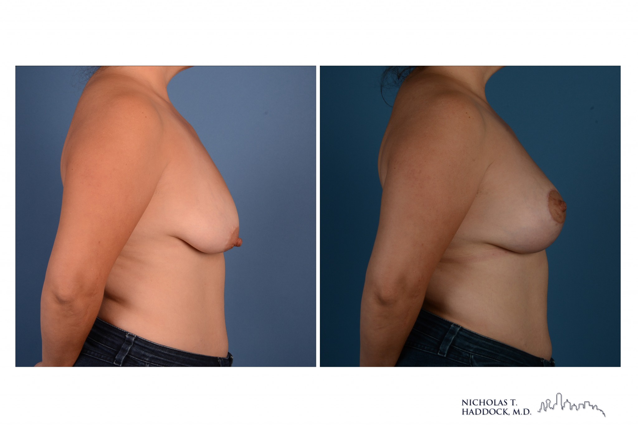 Breast Augmentation Mastopexy Breast Augmentation Mastopexy