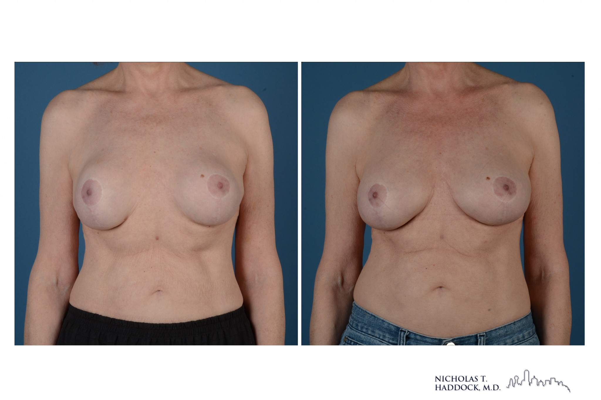 Breast Augmentation Revision Breast Augmentation Revision