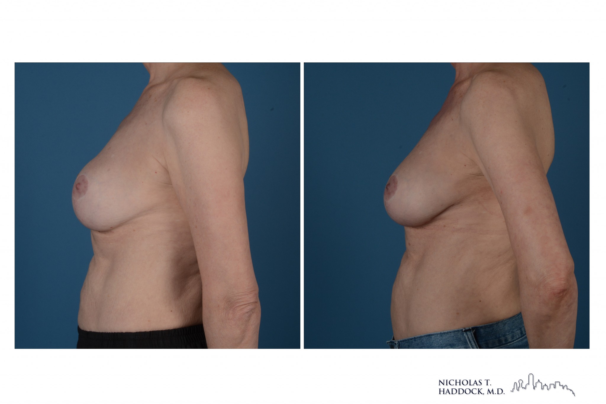 Breast Augmentation Revision Breast Augmentation Revision