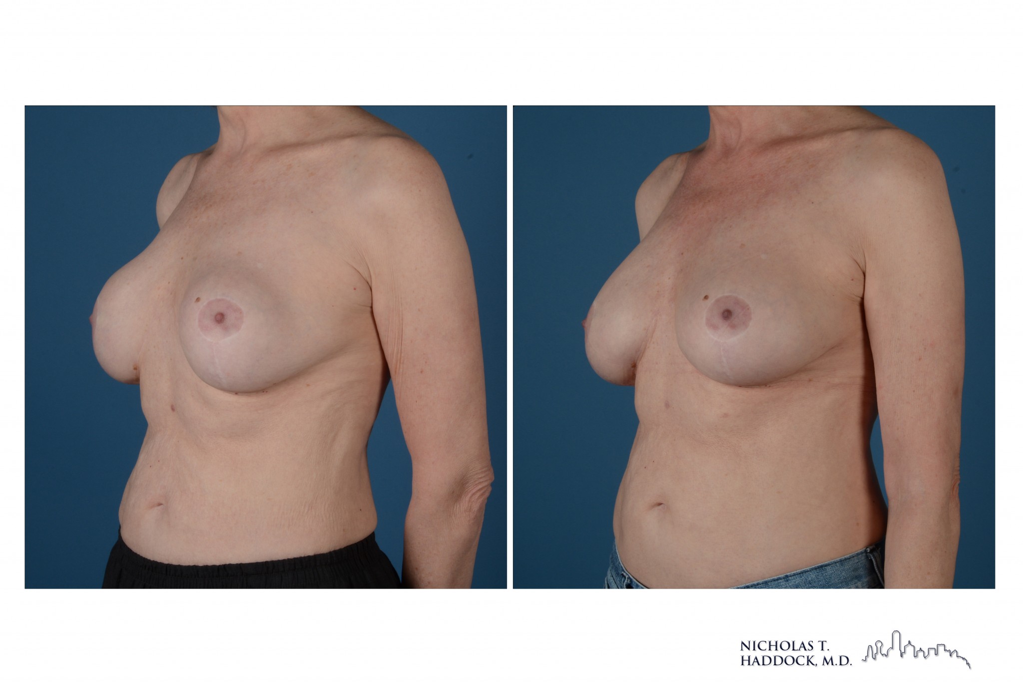 Breast Augmentation Revision Breast Augmentation Revision