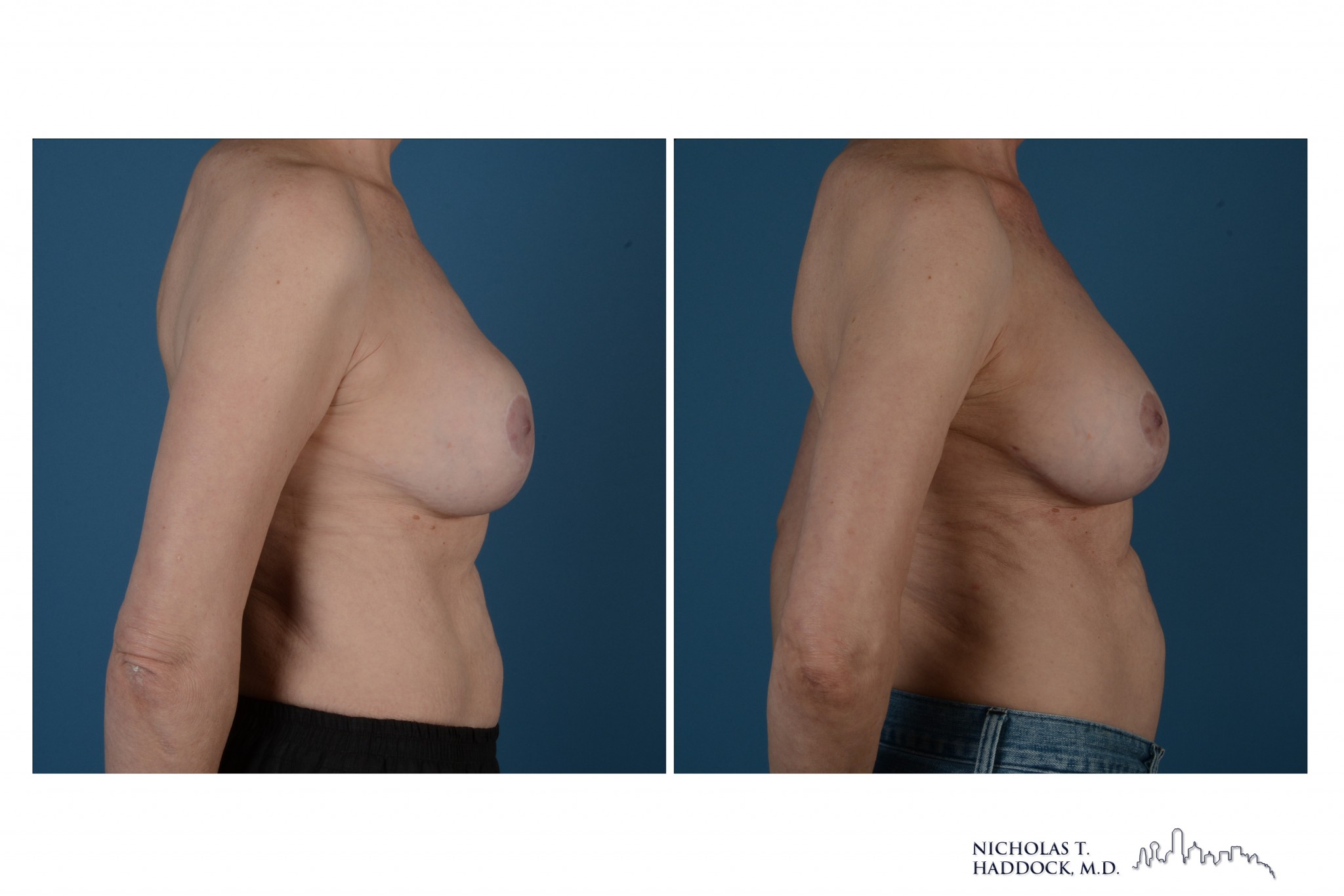 Breast Augmentation Revision Breast Augmentation Revision