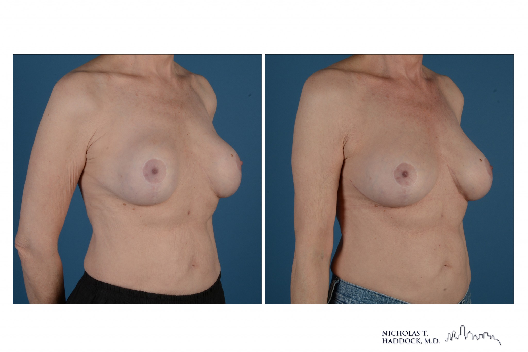 Breast Augmentation Revision Breast Augmentation Revision