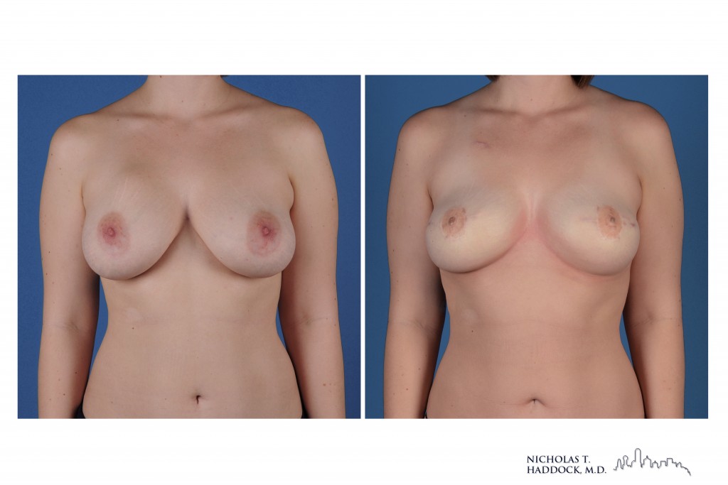 PAP flap before and after