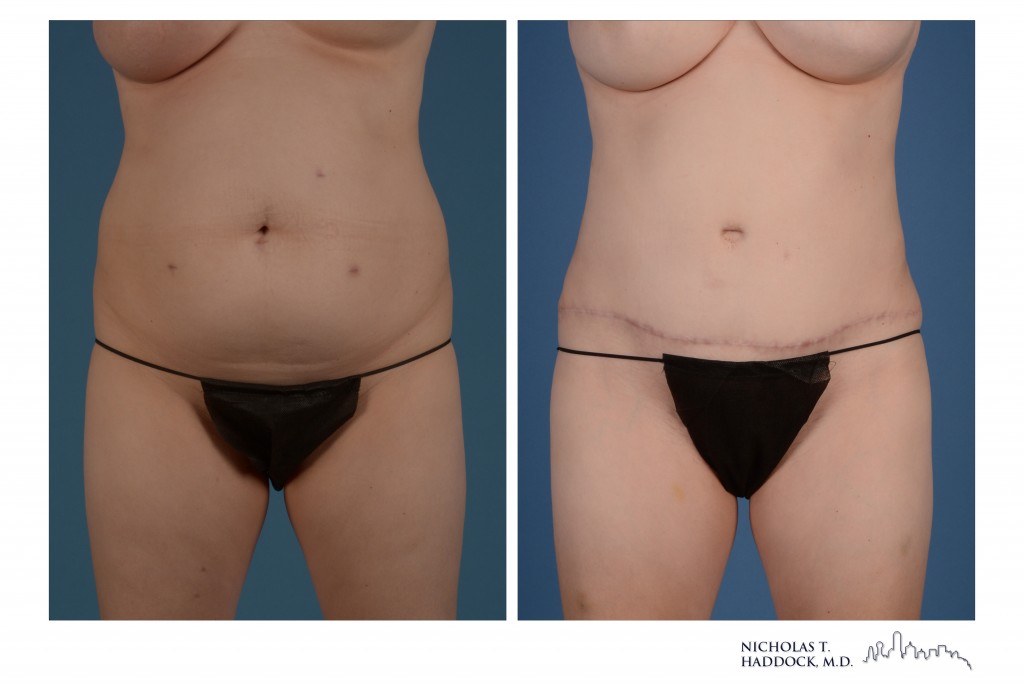 Tummy tuck before and after, front view &mdash; before on the left, after on the right (case 1 of 3)