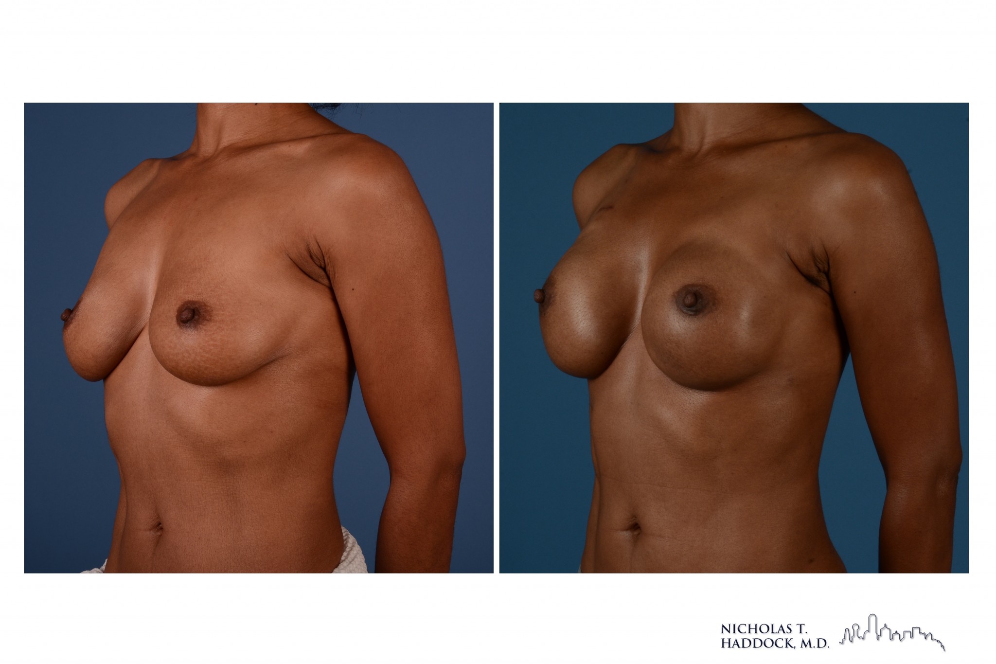 breast implant reconstruction