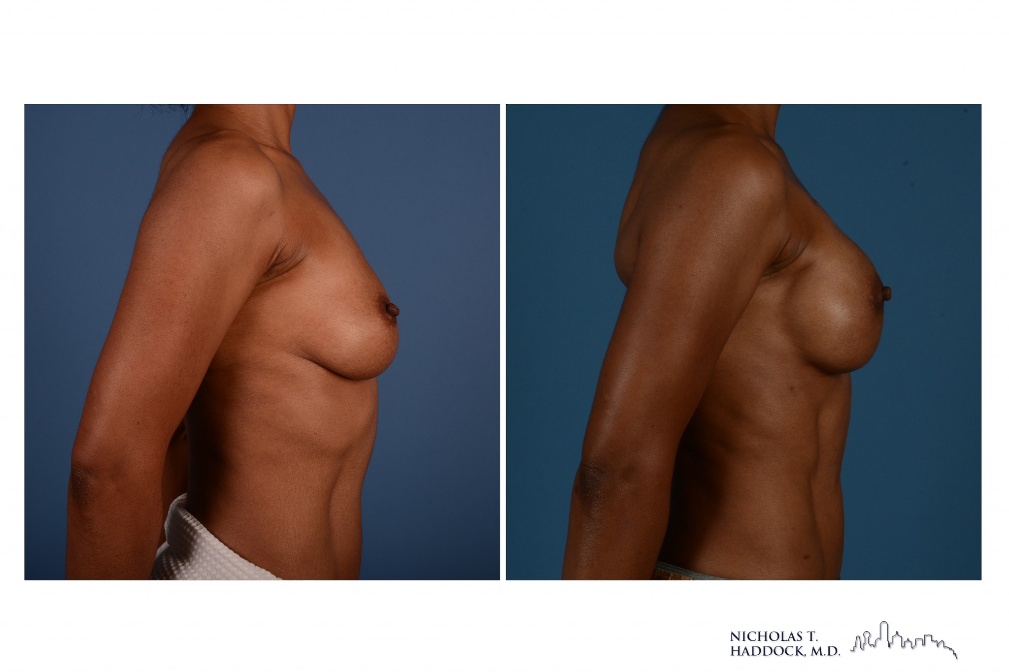 breast implant reconstruction