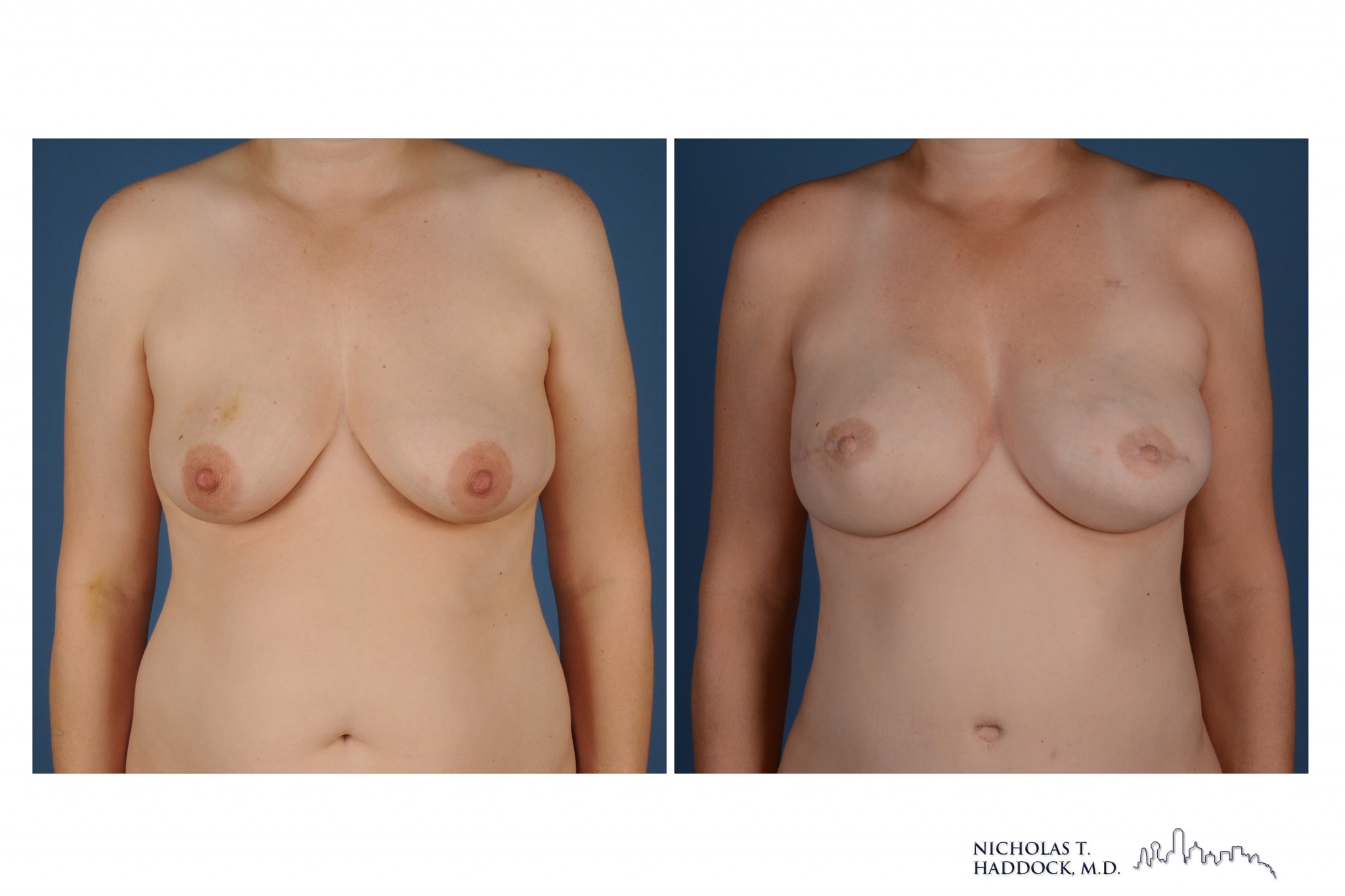 Implant Breast Reconstruction