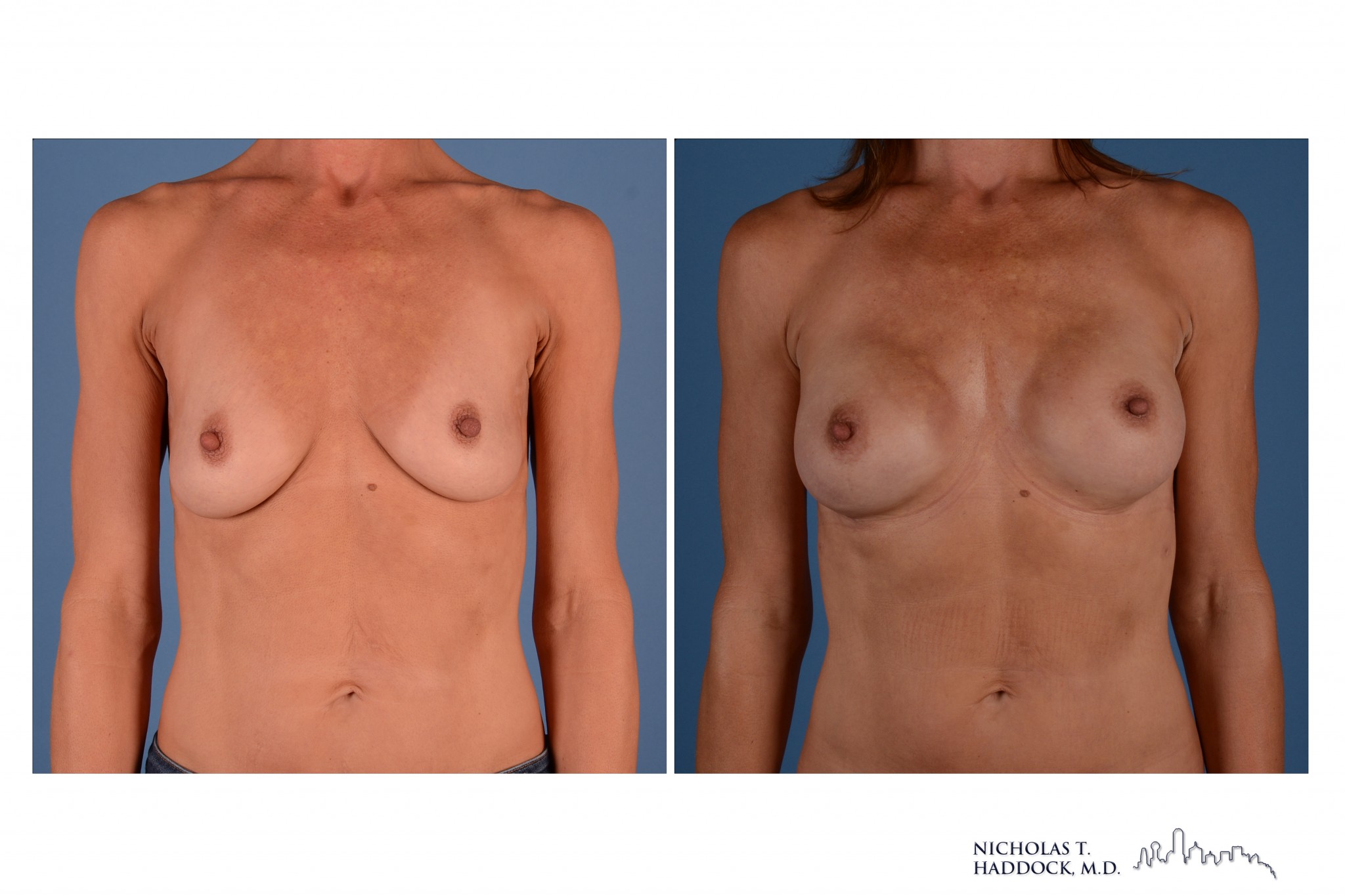 Implant Breast Reconstruction