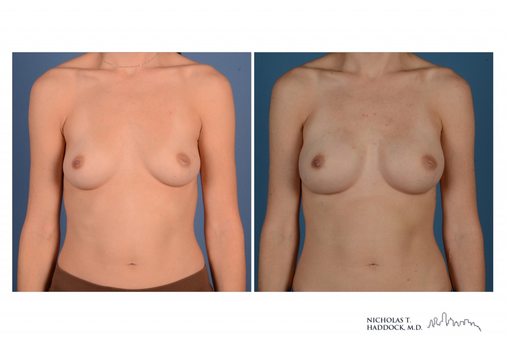 Implant reconstruction before and after