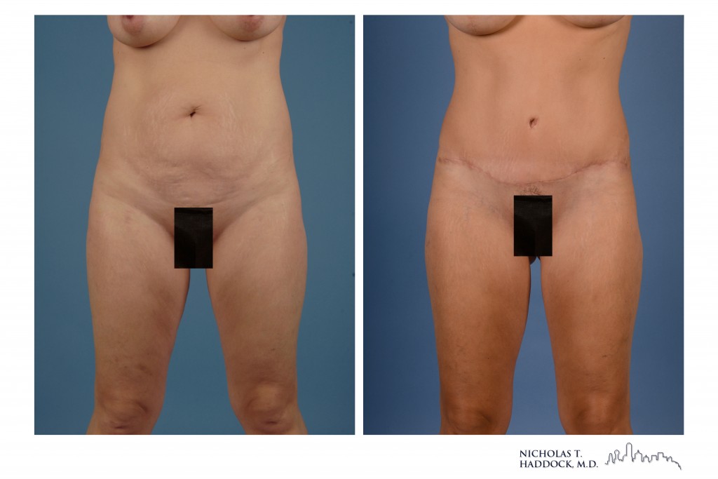 Tummy tuck before and after, front view &mdash; before on the left, after on the right (case 3 of 3)