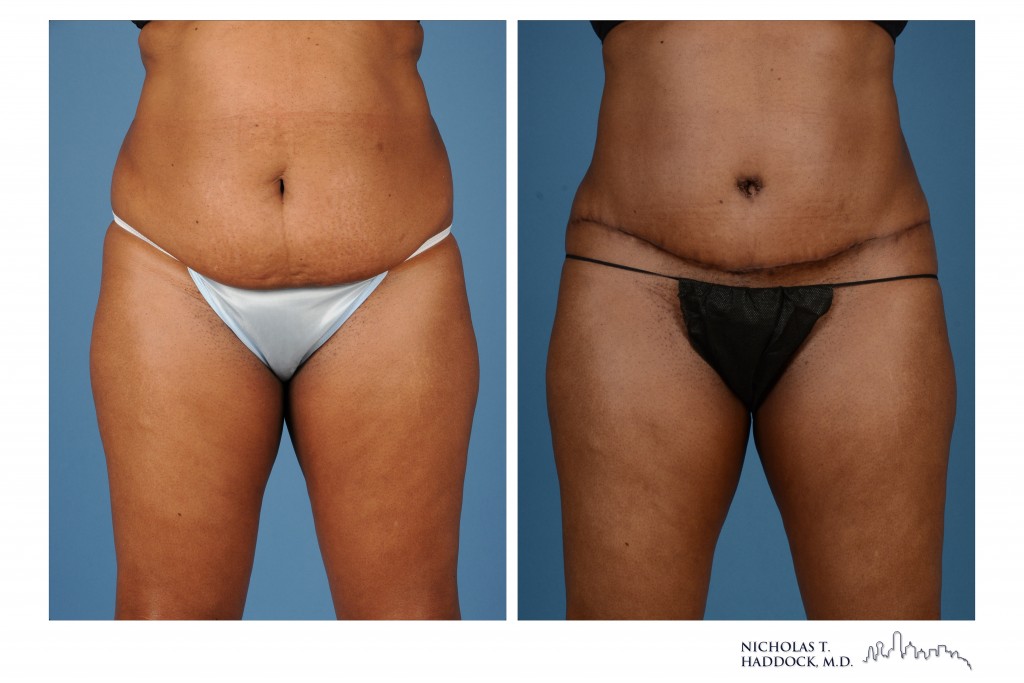 Tummy tuck before and after, front view &mdash; before on the left, after on the right (case 2 of 3)