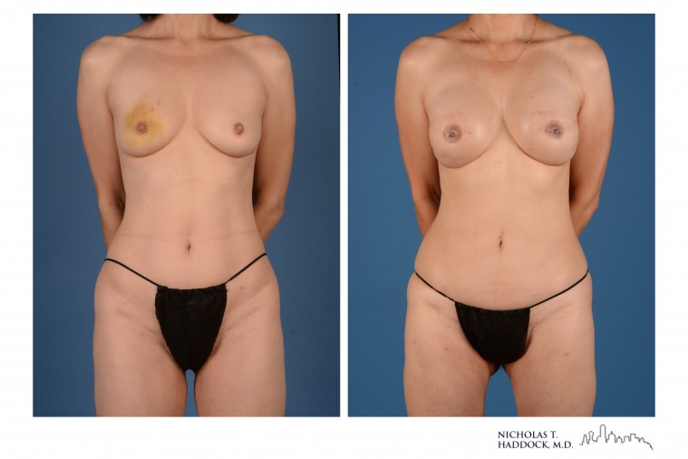 PAP Flap Breast Reconstruction Before and After Photos