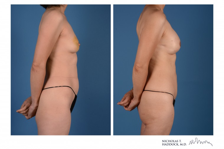PAP Flap Breast Reconstruction Before and After Photos