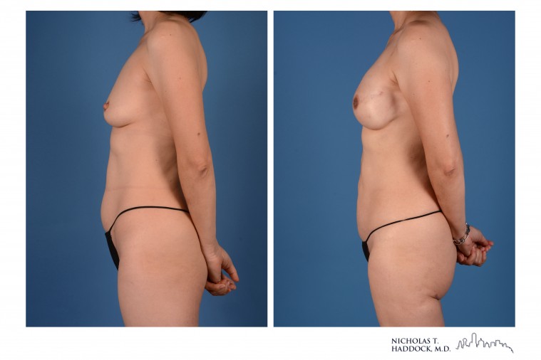 PAP Flap Breast Reconstruction Before and After Photos