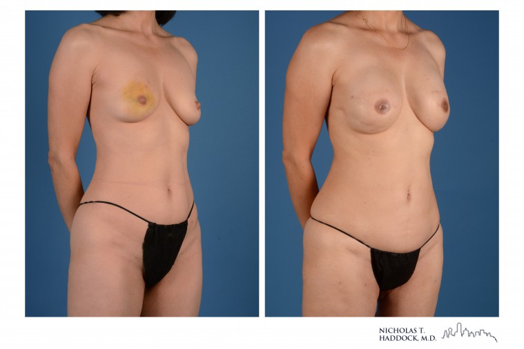 PAP Flap Breast Reconstruction Before and After Photos