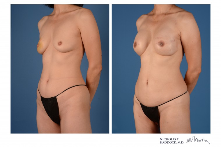 PAP Flap Breast Reconstruction Before and After Photos