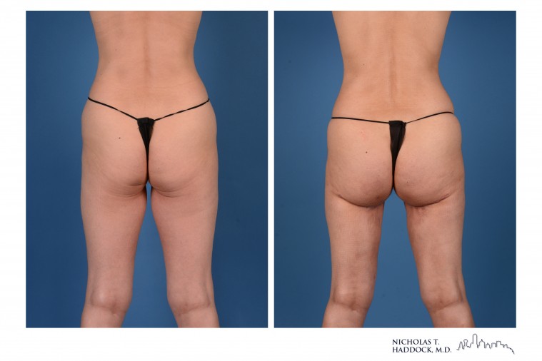 PAP Flap Breast Reconstruction Before and After Photos