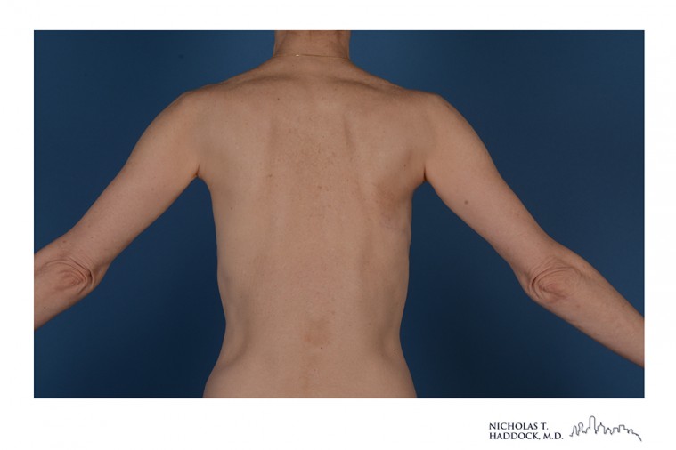 Latissimus Flap