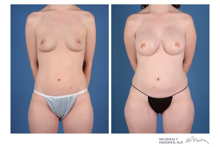 PAP Flap Breast Reconstruction Before and After Photos