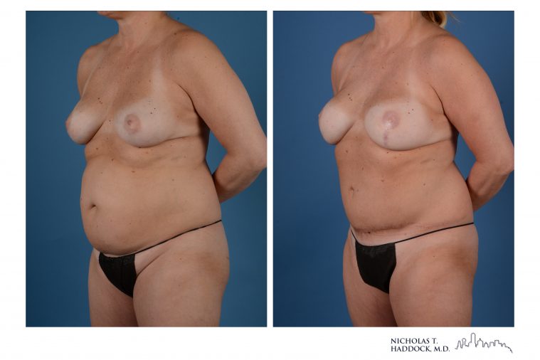 DIEP Flap