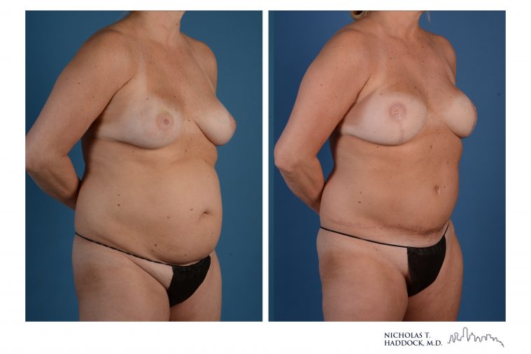 DIEP Flap