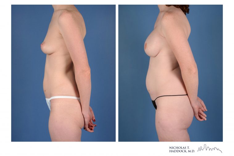 PAP Flap Breast Reconstruction Before and After Photos