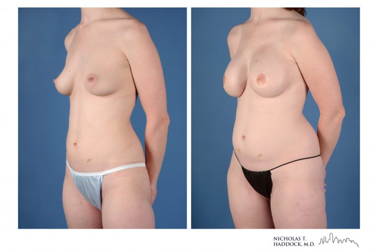 PAP Flap Breast Reconstruction Before and After Photos