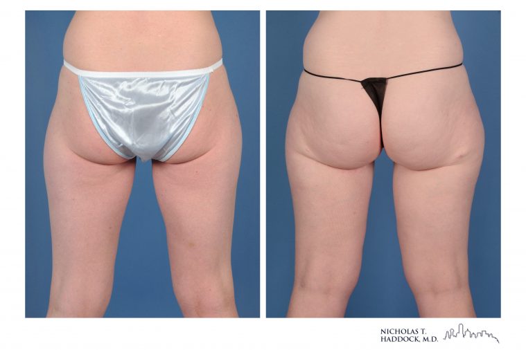 PAP Flap Breast Reconstruction Before and After Photos