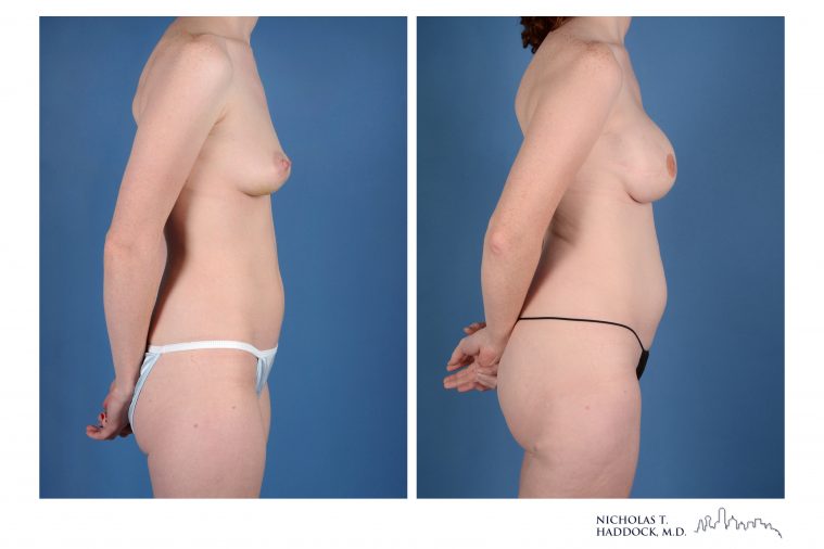 PAP Flap Breast Reconstruction Before and After Photos