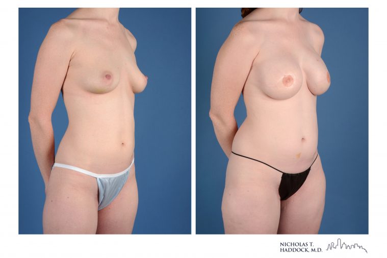 PAP Flap Breast Reconstruction Before and After Photos