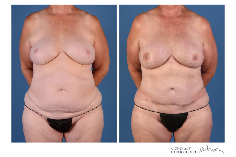 DIEP Flap Before and After Photos DIEP Flap Before and After Photos