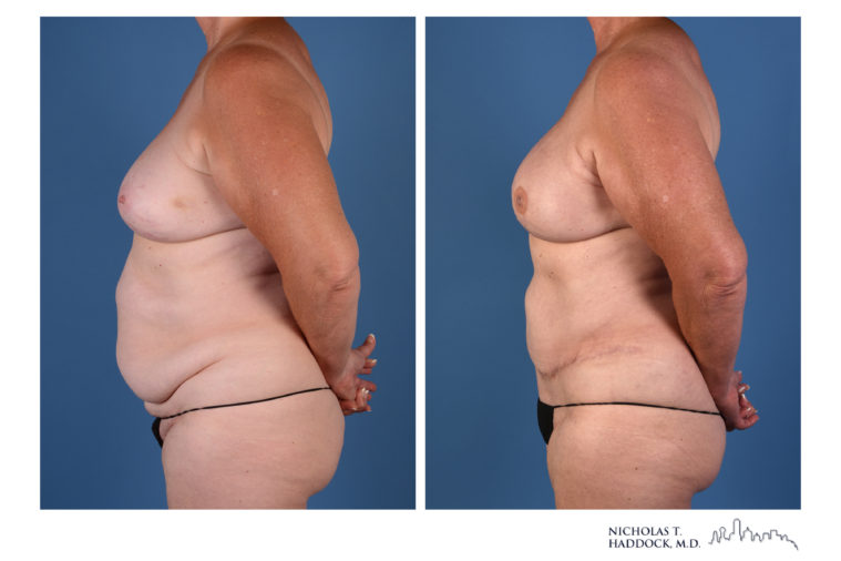 DIEP Flap Before and After Photos DIEP Flap Before and After Photos