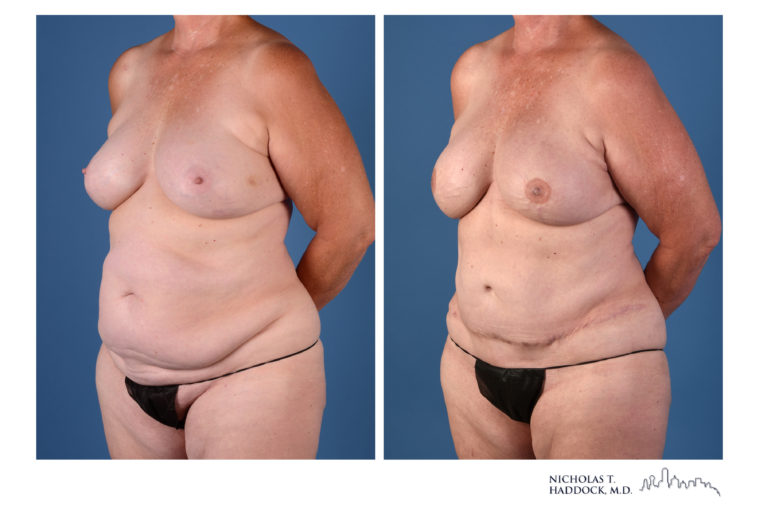 DIEP Flap Before and After Photos DIEP Flap Before and After Photos