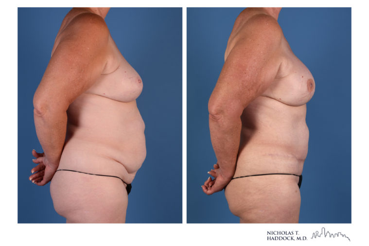 DIEP Flap Before and After Photos DIEP Flap Before and After Photos