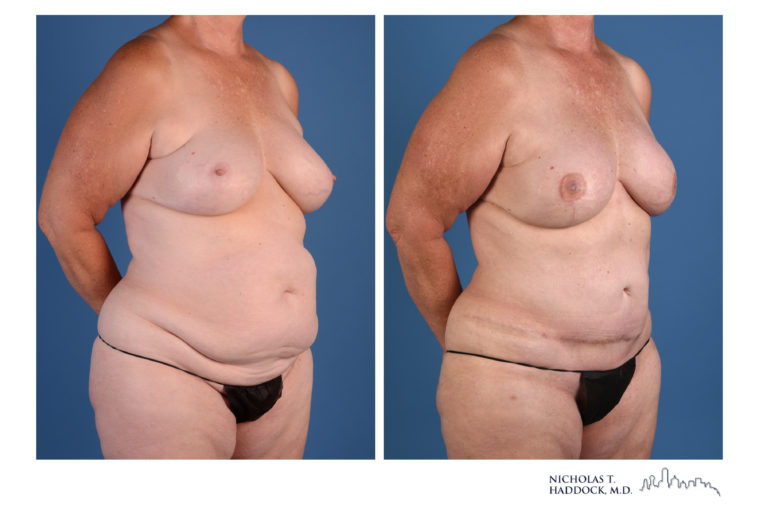 DIEP Flap Before and After Photos DIEP Flap Before and After Photos