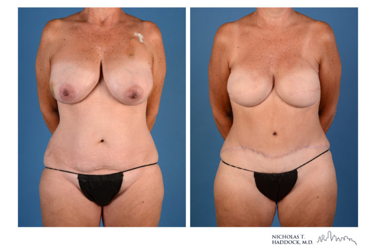DIEP Flap Before and After Photos