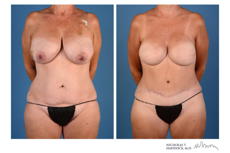 DIEP Flap Before and After Photos DIEP Flap Before and After Photos