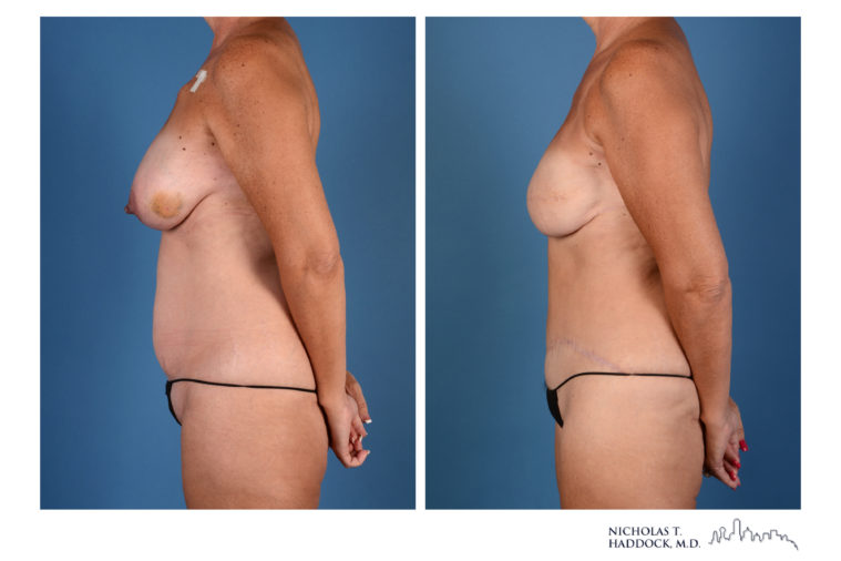 DIEP Flap Before and After Photos DIEP Flap Before and After Photos