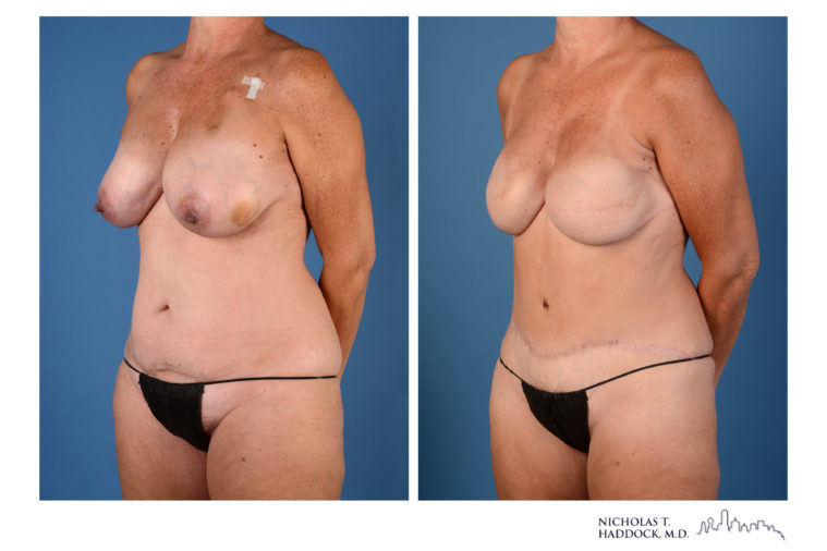 DIEP Flap Before and After Photos