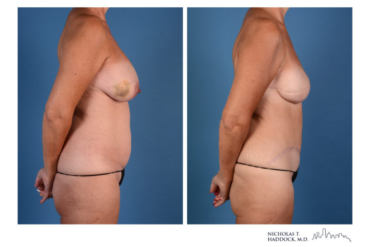 DIEP Flap Before and After Photos DIEP Flap Before and After Photos