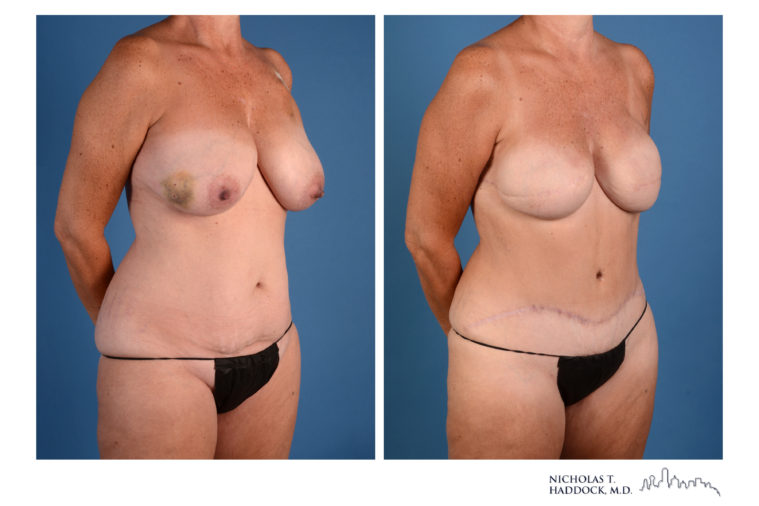 DIEP Flap Before and After Photos DIEP Flap Before and After Photos