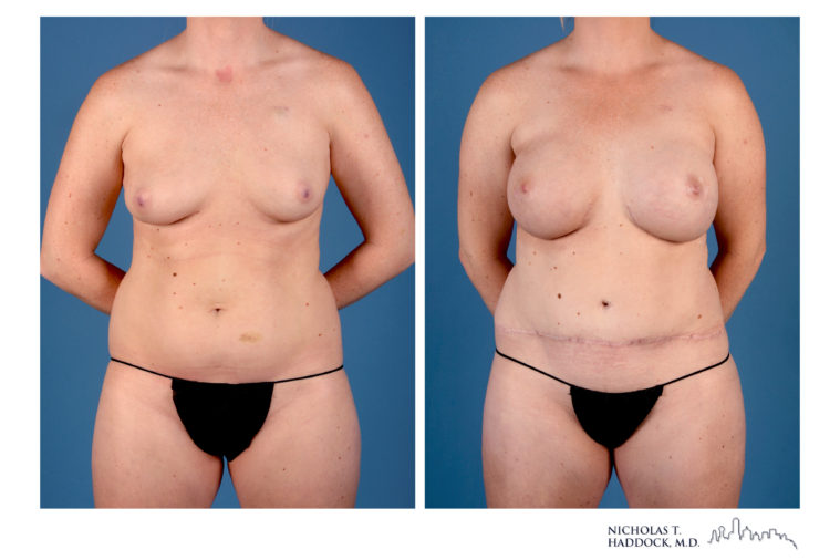 Hybrid DIEP Flap Hybrid DIEP Flap