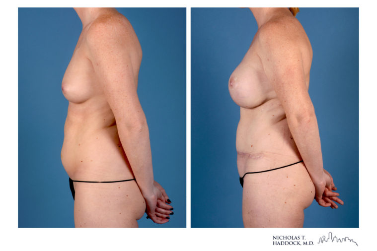Hybrid DIEP Flap Hybrid DIEP Flap